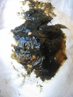 Meconium in luier